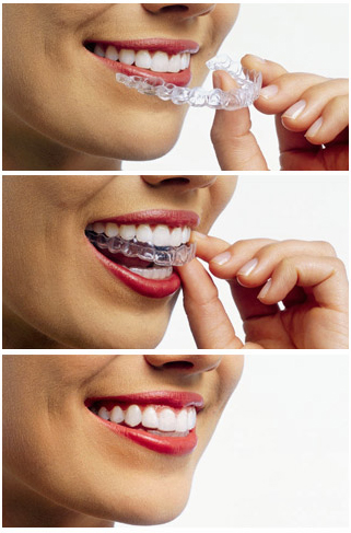 Invisalign  Route 9 Dental