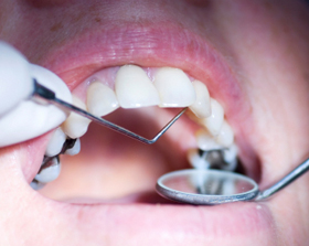 Extraction - Dentist around Randolph NJ